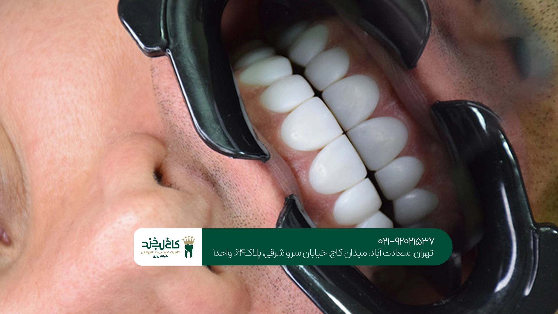تفاوت لمینت سرامیکی با کامپوزیت ونیر